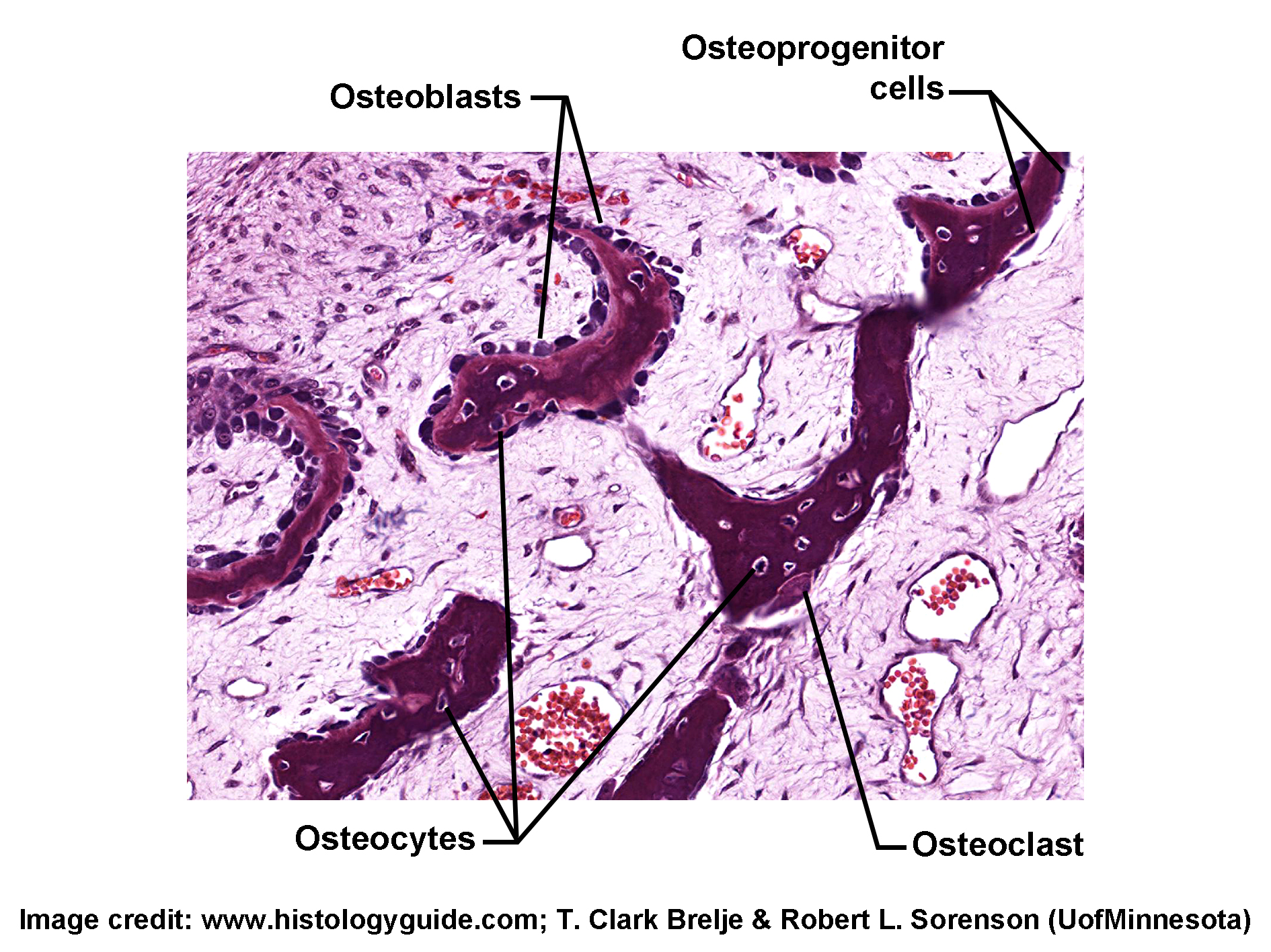 Histological section of bone stained with H&E, showing key bone cell types involved in remodeling. Osteoblasts line the bone surface, actively secreting bone matrix. Osteocytes are embedded within lacunae inside the bone tissue. Osteoclasts, large multinucleated cells, are located along resorption surfaces. Osteoprogenitor cells are present near the bone surface, differentiating into osteoblasts. The image illustrates the cellular components responsible for bone formation and resorption.