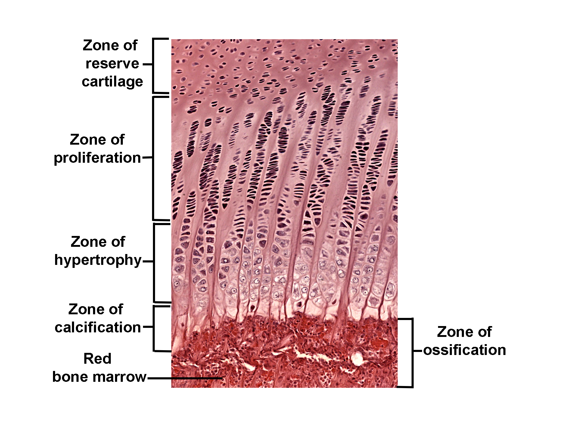 Histological section of an epiphyseal growth plate stained with H&E, showing zones of cartilage and bone development. From top to bottom: • Zone of reserve cartilage: Resting chondrocytes scattered in the matrix. • Zone of proliferation: Columns of flattened chondrocytes undergoing mitosis. • Zone of hypertrophy: Enlarged chondrocytes with clear cytoplasm. • Zone of calcification: Matrix becomes calcified, chondrocytes degenerate. • Zone of ossification: Bone tissue forms with invading blood vessels and marrow. Red bone marrow is visible beneath the ossification zone. The image illustrates endochondral ossification and longitudinal bone growth.