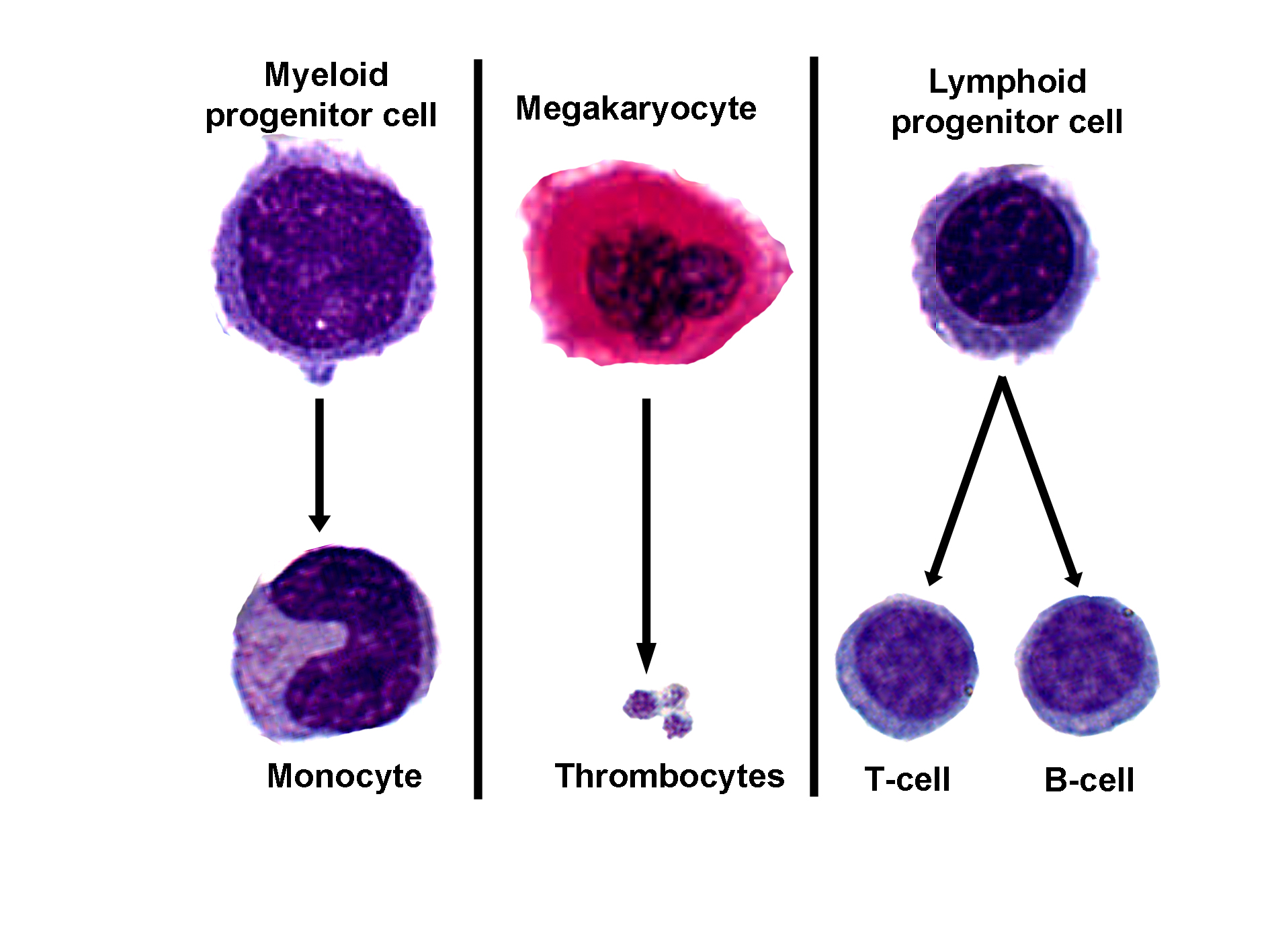 Composite image showing stages of agranulopoiesis and lymphopoiesis. On the left, a myeloid progenitor cell differentiates into a monocyte, depicted as a large cell with an indented nucleus. In the center, a megakaryocyte, a large pink-stained cell with a multilobed nucleus, gives rise to small thrombocytes (platelets). On the right, a lymphoid progenitor cell differentiates into two smaller round cells: a T-cell and a B-cell, both with dense, dark-stained nuclei and minimal cytoplasm. Black arrows indicate the direction of differentiation for each lineage. The image illustrates the development of agranulocytes and lymphocytes from progenitor cells.
