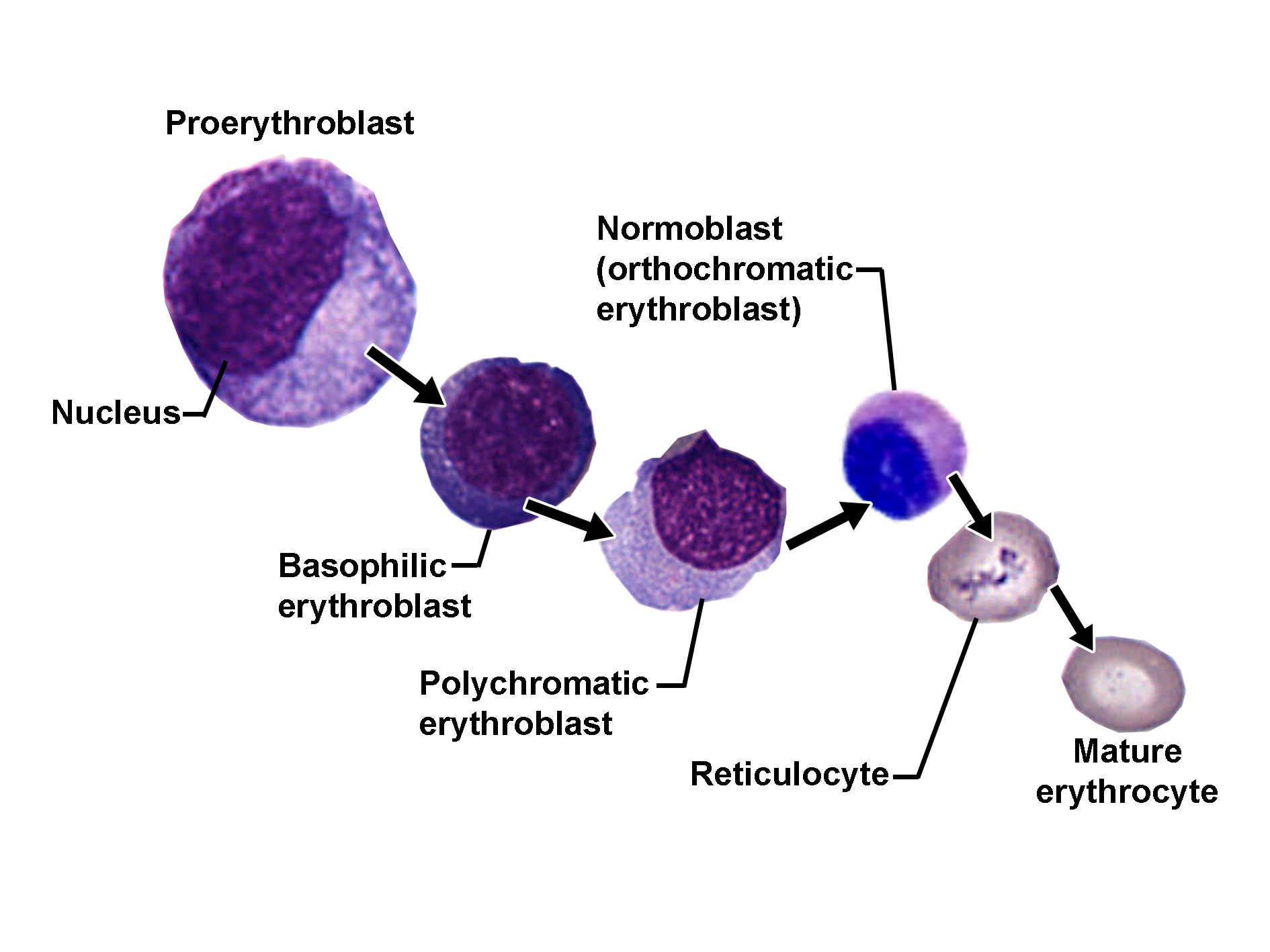 Diagram showing stages of erythropoiesis from a proerythroblast to a mature erythrocyte. The sequence begins with a large proerythroblast with a prominent nucleus, followed by a basophilic erythroblast with deeply stained cytoplasm. Next is a polychromatic erythroblast with mixed staining, then a normoblast (orthrochromatic erythroblast) with condensed nucleus. The nucleus is extruded as the cell becomes a reticulocyte, which later matures into an erythrocyte with a biconcave shape and no nucleus. The image illustrates progressive nuclear condensation and cytoplasmic changes during red blood cell development.