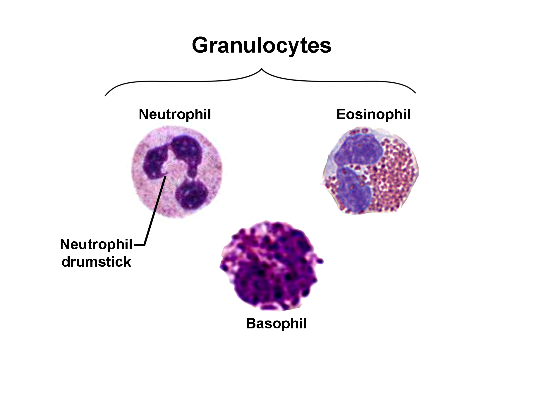 Image showing three types of granulocytes from a blood smear. A neutrophil with a multi-lobed nucleus and fine granules is labeled, including a neutrophil drumstick (Barr body) visible on one lobe. An eosinophil with a bilobed nucleus and large reddish granules is shown to the right. A basophil with a bilobed nucleus obscured by dense purple granules is displayed below. The image illustrates the morphological differences among neutrophils, eosinophils, and basophils.