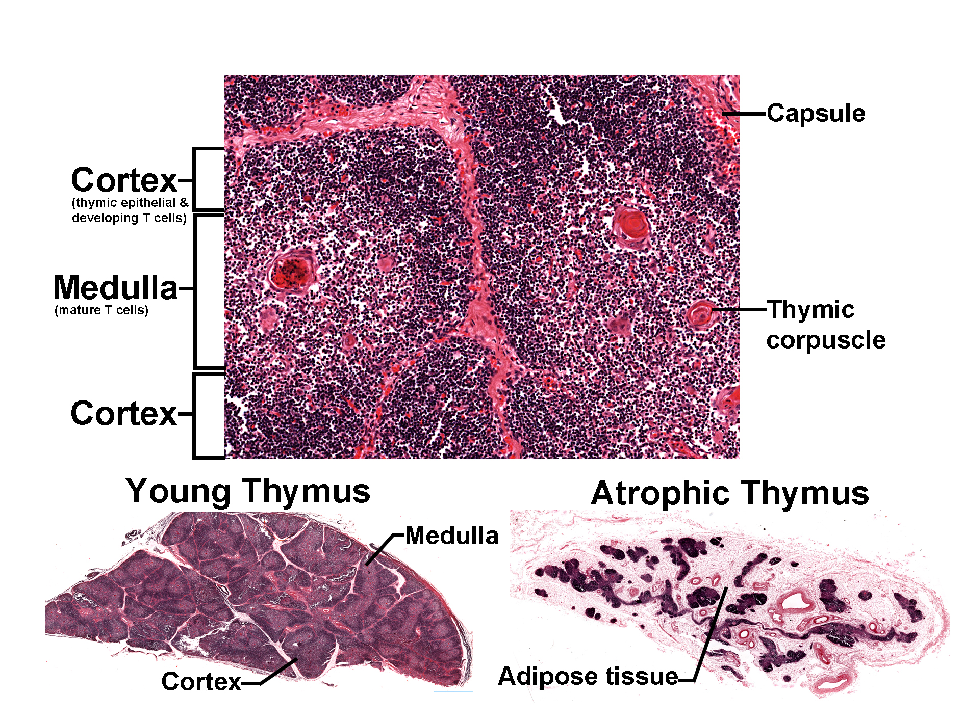 Composite histological image of the thymus stained with H&E, showing structural organization and age-related changes. • Main image: Displays thymic lobules with a dense cortex containing thymic epithelial cells and developing T cells, and a lighter medulla with mature T cells. The capsule surrounds the lobules, and Hassall’s corpuscles are visible within the medulla. • Lower panels: Compare a young thymus with distinct cortex and medulla to an atrophic thymus where adipose tissue replaces functional parenchyma. The image illustrates thymic architecture and involution with age.