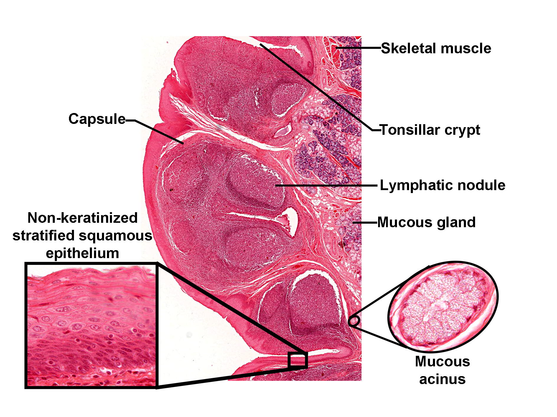 Histological section of the lingual tonsil stained with H&E, showing lymphoid tissue embedded in the posterior tongue. The surface is lined by non-keratinized stratified squamous epithelium, which invaginates to form tonsillar crypts. Beneath the epithelium, the lamina propria contains numerous lymphatic nodules. A fibrous capsule partially surrounds the tonsil, and skeletal muscle fibers are visible deeper in the section. Mucous glands are present near the capsule, with mucous acini highlighted in an inset. Another inset shows the epithelial layer in detail, illustrating multiple cell layers without keratinization. The image demonstrates the lingual tonsil’s immune role and its association with glandular tissue and tongue musculature.