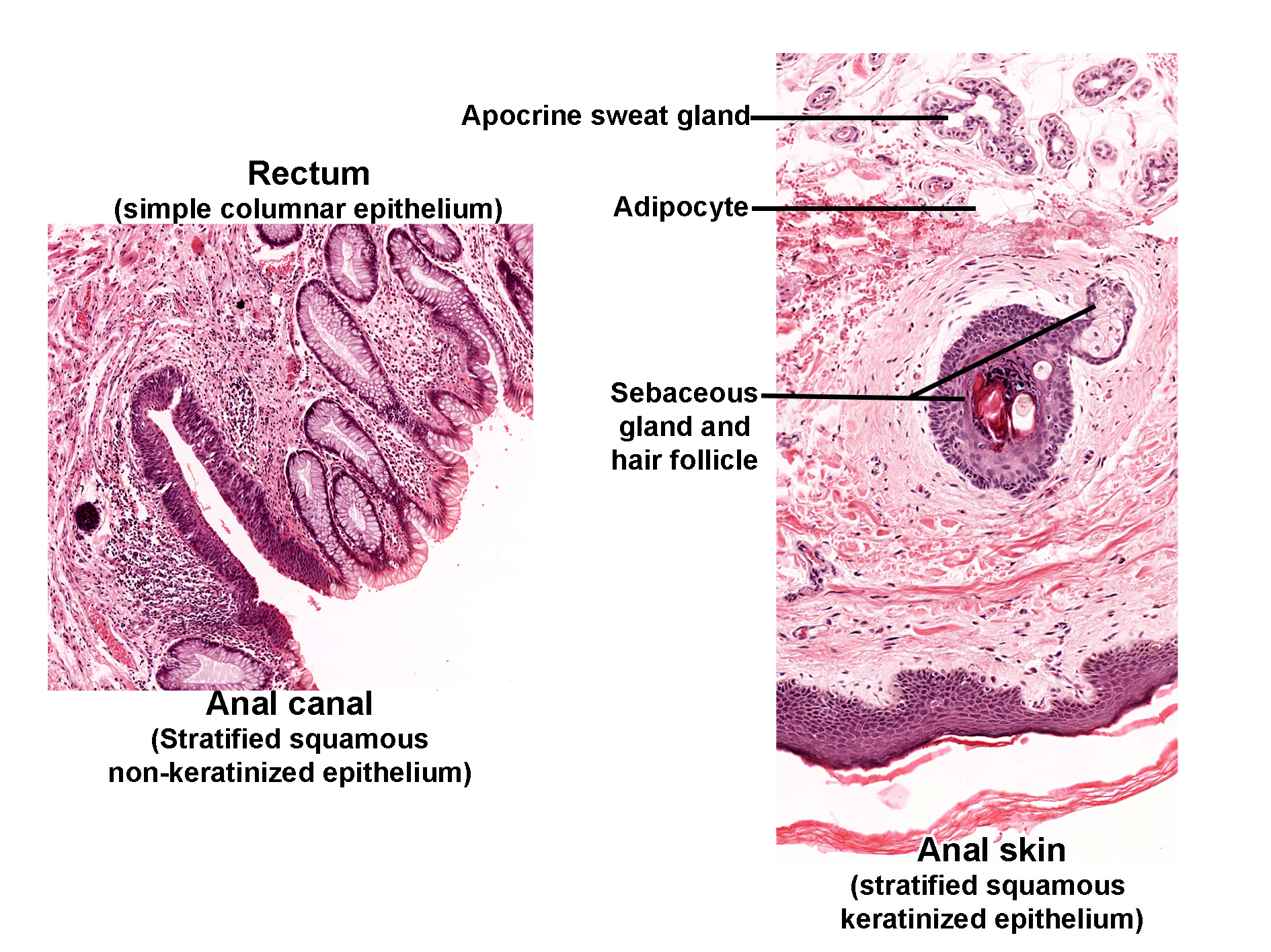 Histological section showing the junction between the rectum, anal canal, and anal skin stained with H&E. The left panel illustrates the rectum lined by simple columnar epithelium transitioning to the anal canal lined by stratified squamous non-keratinized epithelium. The mucosa of the rectum contains tubular glands, while the anal canal shows a thicker stratified squamous layer. The right panel displays anal skin with stratified squamous keratinized epithelium. Within the dermis, a sebaceous gland and hair follicle are visible, along with an apocrine sweat gland and adipocytes in the surrounding connective tissue. The image highlights the epithelial transition from rectum to anal canal and the presence of skin adnexal structures in the anal region.