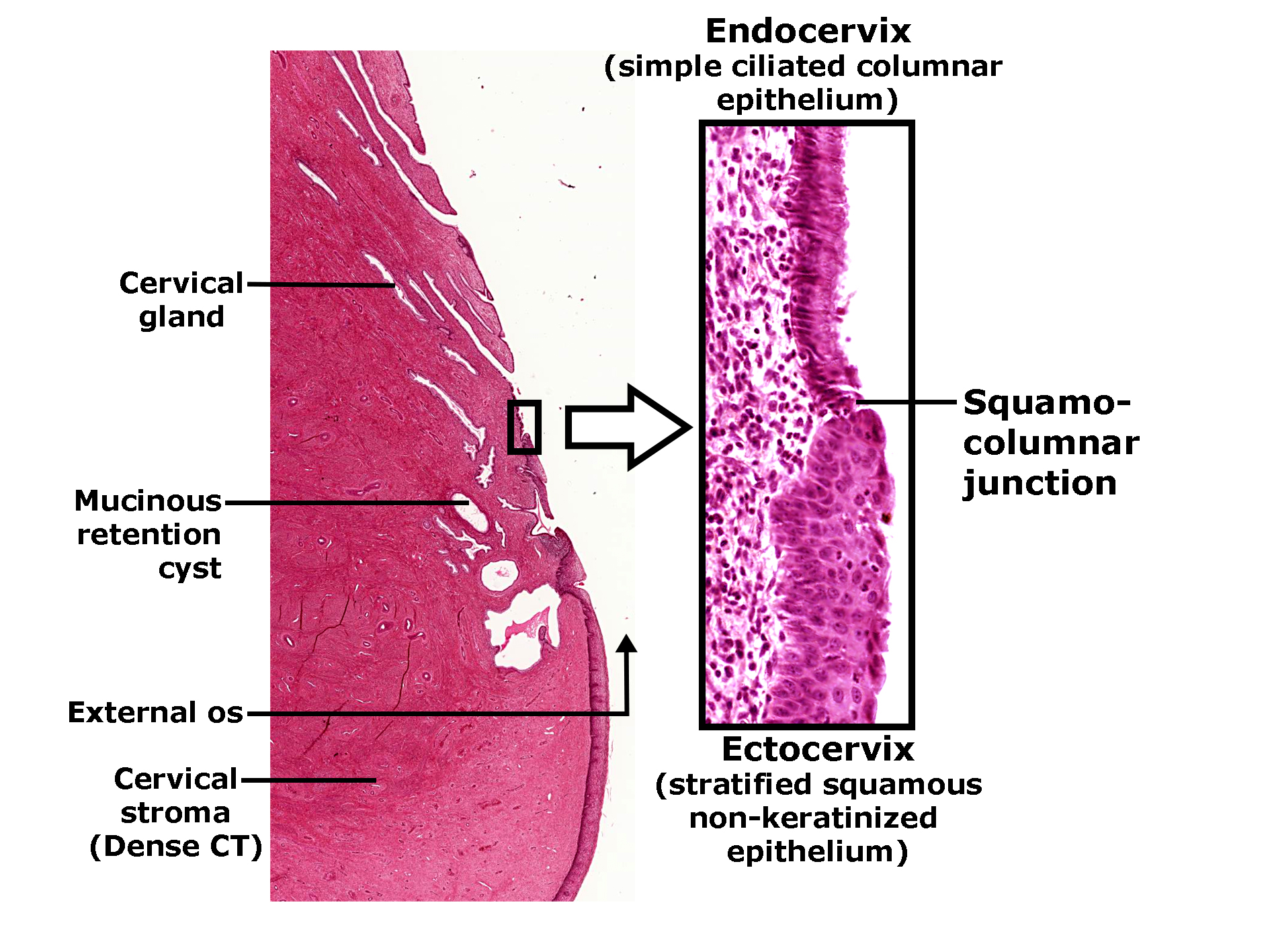 Histological images of the cervix stained with H&E. On the left if a low magnified view of the junction between the ectocervix (at the top) and the endocervix (at the bottom). The tissue is dense pink (acidophilic) and labelled as Cervical stroma (dense connective tissue). It contains several irregular holes near the junction which have been labelled as Mucinous retention cysts. Oblique long channels run in the top of the section, the ectocervix, which are labelled as cervical glands. An arrow points to the lumen (the space adjacent to the epithelial lining of the ectocervix and labelled as the External os. A small black box highlights the transition between endo- and ectocervix with a large arrow pointing to a magnified view of this junction. At the top of the magnified image is a label Endocervix (simple ciliated columnar epithelium). The image shows the epithelial transformation zone from the simple ciliated columnar epithelium of the endocervix to the stratified squamous non-keratinized epithelium of the ectocervix. A line indicates the exact transition and labels it as the squamo-columnar junction. At the bottom of the magnified image is a label Ectocervix (stratified squamous non-keratinized epithelium).